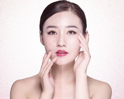 認識常見的四種色素斑與它的成因