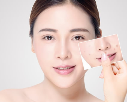 戰「痘」失敗？換個方式，再試一次 (上)