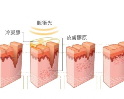 全能肌膚保養型雷射-脈衝光