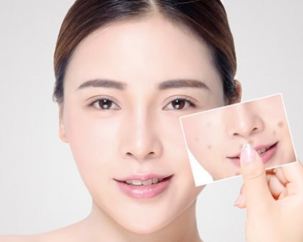 痘痘肌也要敷臉？看這篇!