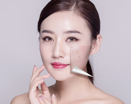 一敷面膜就長痘？三個原因告訴你！